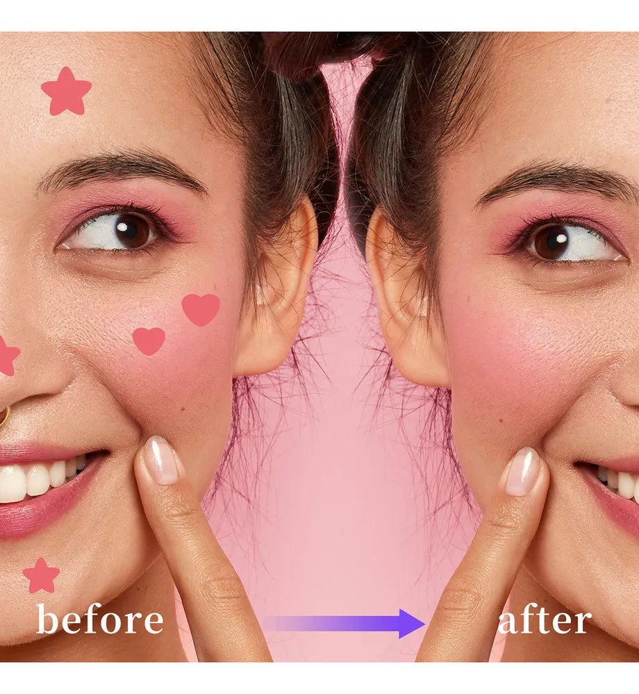 Invisible Star-Shaped Hydrocolloid Patch for A